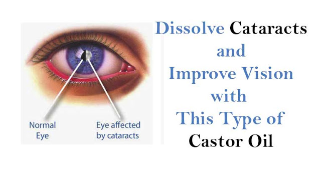 How to Remove a Cataract and Get 20/20 Vision with Castor Oil